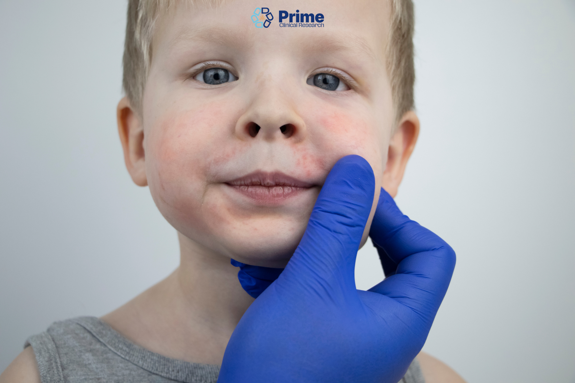 Severe Atopic Dermatitis
