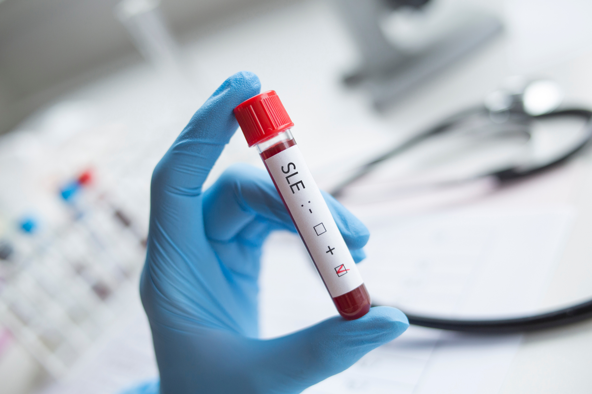 Systemic Lupus Erythematosus